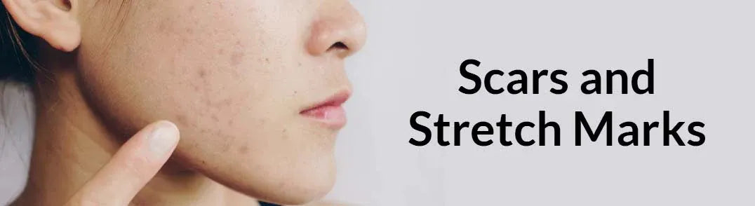 Scars and Stretch Marks
