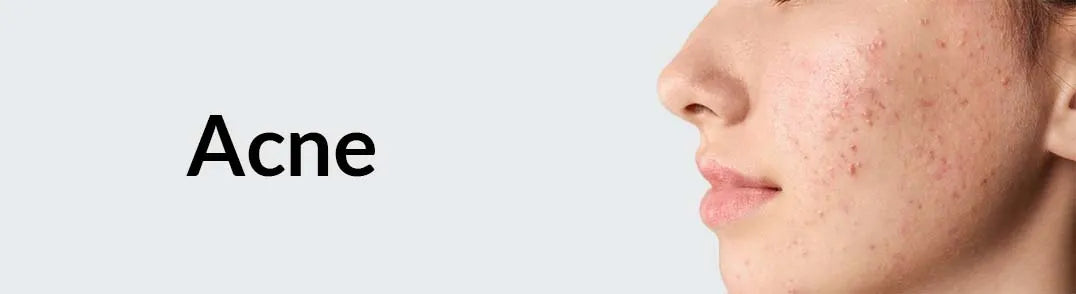 Salyzap - Acne care Products