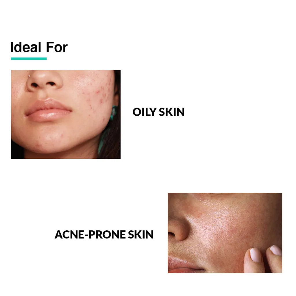 Anti-Acne Face Serum | 5% Azelaic acid, 4% Mandelic acid, 2% Salicylic acid serum
